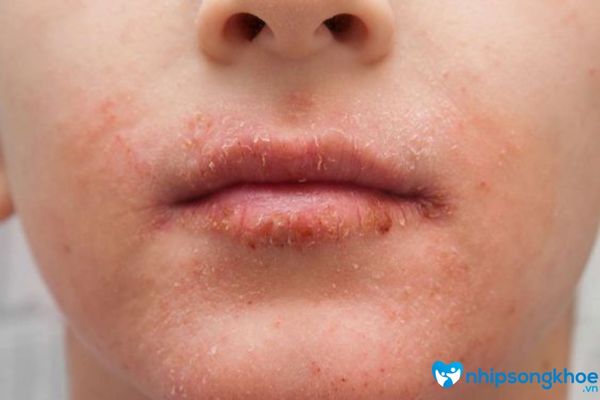 Da mặt bị khô sần và ngứa là tình trạng bề mặt không phẳng mịn, da nhấp nhô bởi mụn hoặc lỗ chân lông to và khô