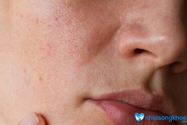 Da mặt bị rỗ là tình trạng da mặt bị tổn thương nghiêm trọng
