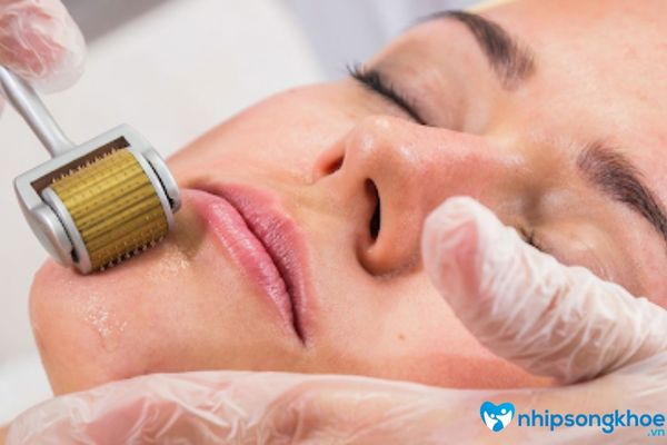 Phương pháp lăn kim trong điều trị da mặt bị rỗ