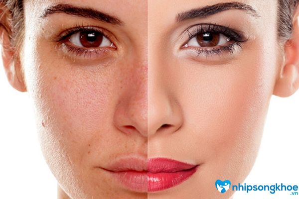 da mặt bị sạm đen bản chất là sự tăng tích tụ sắc tố da melanin - chất tạo sắc màu trên da