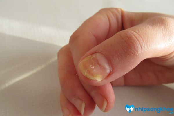 Móng tay lõm là hiện tượng một phần của móng tay bị lõm xuống, khiến móng tay gồ ghề