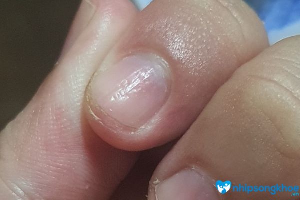 Móng tay bị sần sùi là tình trạng bề mặt móng tay không được nhẵn mịn do một số nguyên nhân gây ra 