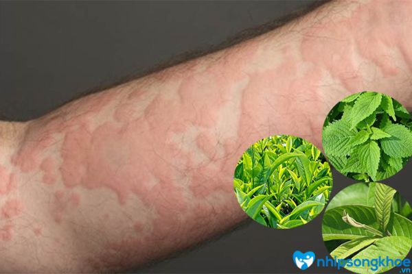 Nước lá trà xanh giúp làm giảm tình trạng nổi mẩn ngứa như muỗi đốt