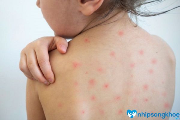 Trẻ sơ sinh bị nổi mẩn đỏ ở lưng do sốt phát ban 