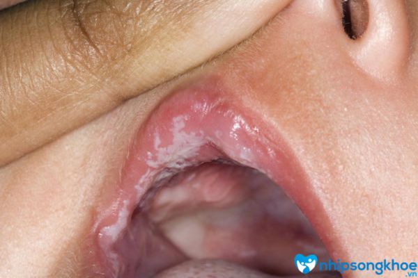 Trẻ sơ sinh bị rộp trắng ở môi do không được chăm sóc miệng 