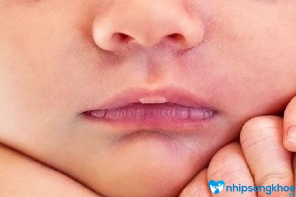 Dấu hiệu nhận biết trẻ bị rộp trắng ở môi 