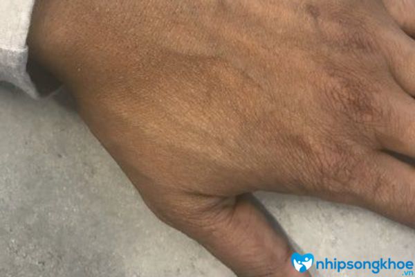 Da tay sạm đen là tình trạng ở trên da có những vết đen bất thường thành mảng