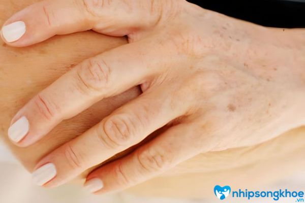 Da tay bị nổi đốm nâu hình thanh do thay đổi các sắc tố melanin trong da