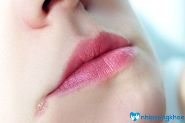 Chốc mép thường xuất hiện ở phía mép môi gây ngứa ngáy cũng như khó chịu cho người bệnh