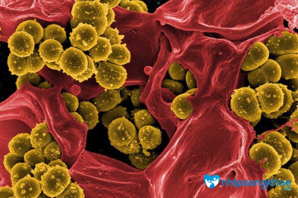 Mụn lẹo thường do vi khuẩn Staphylococcus aureus gây nên
